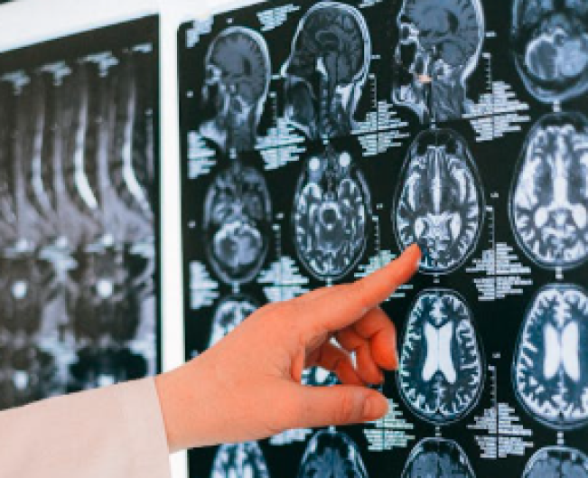 Waspadai 5 Tanda Kanker Otak Ganas Ini, Penyanyi Michael Bolton Berjuang Menghadapi Glioblastoma